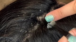 Picking and combing through dandruff psoriasis scalp scratching flare up [upl. by Innob]