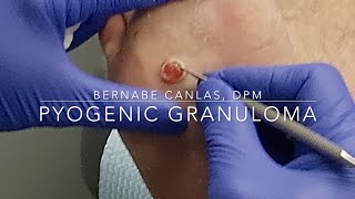 Pyogenic Granuloma [upl. by Adev]