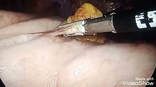 Laparoscopic Nissen fundoplication for Hiatal Hernia with GERD Za Abuja [upl. by Brigid159]