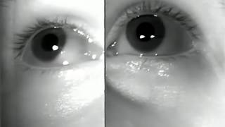 WallEyed Bilateral Internuclear Ophthalmoplegia WEBINOMoran226 [upl. by Huskey]