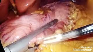 Laparoscopic sleeve gastrectomy and appendectomy for morbid obesity and appendicitis [upl. by Yriek]