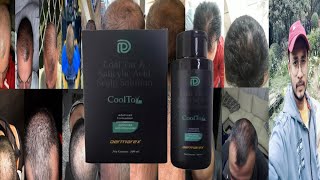 Dermarex Coal Tar Salicylic Acid Scalp Solution  Honest Review [upl. by Pressman]