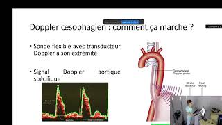 Monitorage hémodynamique du patient en fibrillation atriale au bloc opératoire [upl. by Derk335]