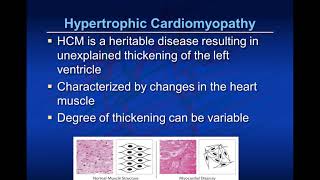 Pediatric Cardiomyopathy 101 [upl. by Curnin]