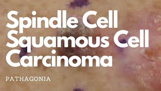 Spindle Cell Carcinoma SLAM Differential pathagonia [upl. by Zurciram]