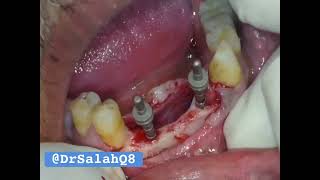 Immediate implant  surgical delayed implant  Flapless implant placement all at the same time [upl. by Eimmak]