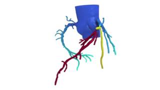 New noninvasive test to detect clogged coronary arteries [upl. by Friedlander]