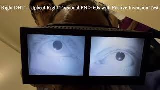 Right Posterior Semicircular Cupulolithiasis with Positive Inversion Test [upl. by Astor]