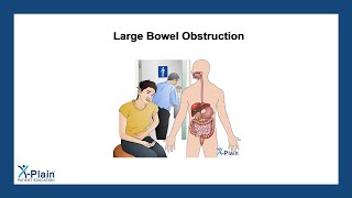 Large Bowel Obstruction [upl. by Morrell890]