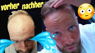 Haartransplantation 8 Monate Ergebnis Vorher Nachher 😱 [upl. by Adnilec205]