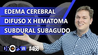 EDEMA CEREBRAL DIFUSO x HEMATOMA SUBDURAL SUBAGUDO [upl. by Anigar]