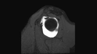 SLAP lesion tear posterior labrum and sublabral foramen of the shoulder  complete MRI examination [upl. by Lantz842]