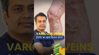 Whats the REAL Cost of Varicose Veins Treatment varicoseveins budget shorts [upl. by Airamalegna]