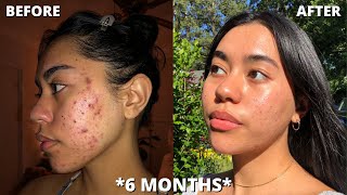 Differin Gel Adapalene 01 6 MONTH RESULTS [upl. by Otsugua]