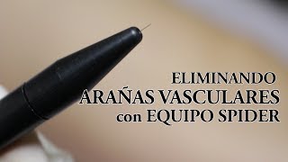 Eliminar Arañas Vasculares o Telangiectasia con Termocoagulación Equipo Spider [upl. by Ninos]