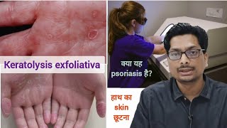 हाथ का skin छूटना  क्या यह psoriasis है Keratolysis exfoliativa  Peeling of hand skin psoriasis [upl. by Intisar19]