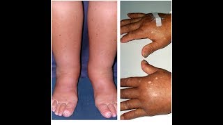 Natural Home Remedies For Swollen FeetWater Retention [upl. by Ravi]