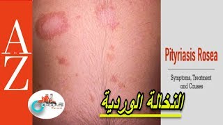 Pityriasis Rosea From A to Z  النخالة الوردية  اعراضها واسبابها  تطور المرض  كل اربعاء [upl. by Atiruam]