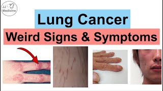 Lung Cancer Weird Signs and Symptoms  Paraneoplastic Syndromes of Lung Cancer [upl. by Asilenna]