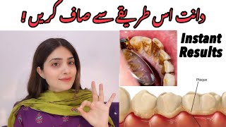 The 1 top remedy for dental plaque TARTAR [upl. by Glover]