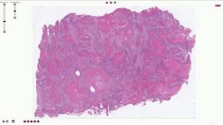 Histopathology  Squamous Cell Carcinoma of the Lung [upl. by Adian192]