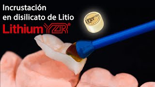 Incrustación en disilicato de litio Lithium YZR [upl. by Zora]