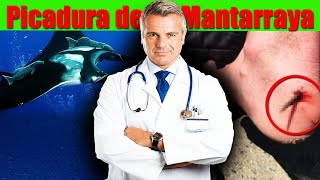 COMO TRATAR una PICADURA de MANTARRAYA [upl. by Annatnas]