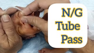 Nasogastric NG Tube insertion in neonateNewborn  How to place a nesogastric  NG feeding tube [upl. by Jung]