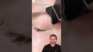 Eyelid CO2 Laser Treatment Surgeon Reacts [upl. by Groome]