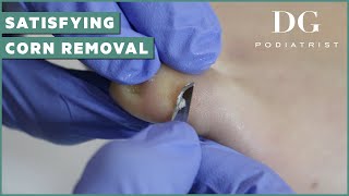 Satisfying corn removal on pinky toe  The Foot Scraper DG Podiatrist [upl. by Janik]