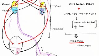 Hemiplegia CVA  Stroke  Theory amp Clinical discussion [upl. by Goldenberg]