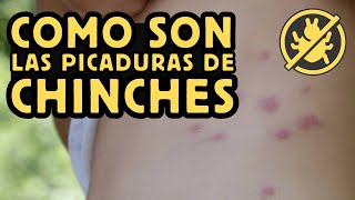 Como son las PICADURAS de las CHINCHES de CAMA [upl. by Releehw]