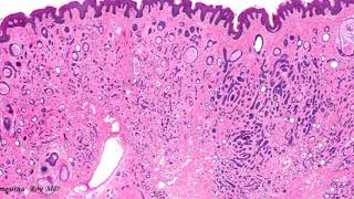 Pathology of Syringoma by Dr Sampurna Roy MD [upl. by Gunzburg]