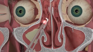 Chapter 3 Nasal and Sinus Problems and Solutions [upl. by Nocaed]