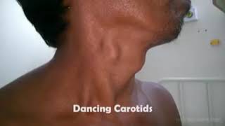 Dancing carotid aortic regurgitation 👇 read description [upl. by Debora]