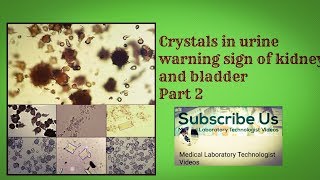 Crystals in Urine  Health warning sign of Kidney and bladder Part 2 [upl. by Dickey]