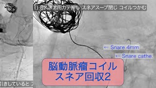 脳動脈瘤コイル スネアで回収 ステントにひっかかった [upl. by Anik103]