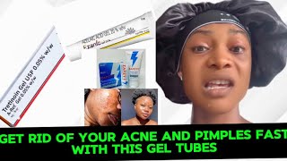 HOW TO GET RID OF SEVERE ACNE✨PIMPLES✨WHITEHEADS✨BLACKHEADSGEL TUBES CREAM FOR ACNE PRONE SKIN [upl. by Klaus]