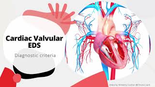 CardiacValvular Ehlers Danlos Syndrome Diagnostic Criteria [upl. by Eihtur]