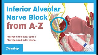 Inferior Alveolar Nerve Block  AZ [upl. by Dniren]