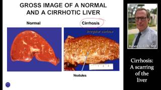 CIRRHOSIS LIVER SCARRING by Dr Robert Gish [upl. by Herring]