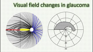 Visual field changes in glaucoma [upl. by Ylrebme]