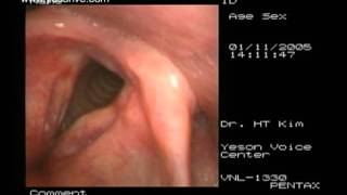 Laryngoplasty of sulcus vocalis [upl. by Paryavi402]