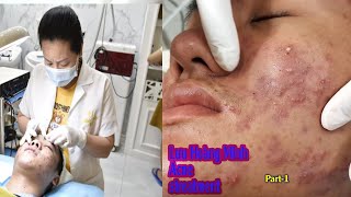 Acne treatment reputation effective at Hien Van Spa380I Lưu hoàng Minh [upl. by Suoicserp76]