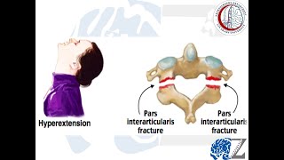 Spine Trauma 9 Hangman’s Fracture 1 كسور الفقرة العنقية الثانية [upl. by Enirehs]