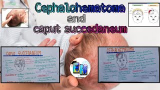 birth Injury 2 caput succedaneum and cephalohematoma  easymedicineLearning [upl. by Zaccaria]