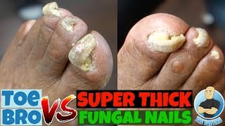 Trimming of Super Thick Fungal Nails FULL TREATMENT [upl. by Mharba]