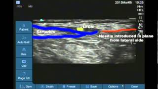 Ultrasound guided lateral femoral cutaneous nerve of thigh block [upl. by Scholem]