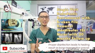 BONE REGENERATION PREVAILS FOLLOWING PROPER ROOT CANAL RETREATMENT IN CHRONIC ABSCESS SINGLE VISIT🦷 [upl. by Lucrece]