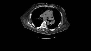 Pulmonary Sarcoidosis [upl. by Anale81]